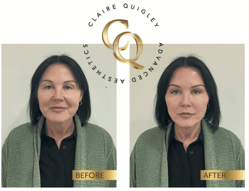 8 point facelift before & after